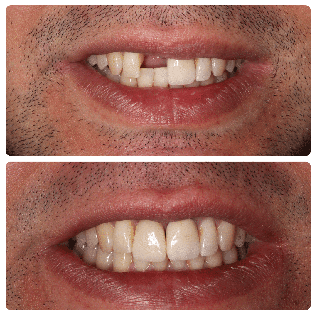 implante-dental-soludent implante dental soludent