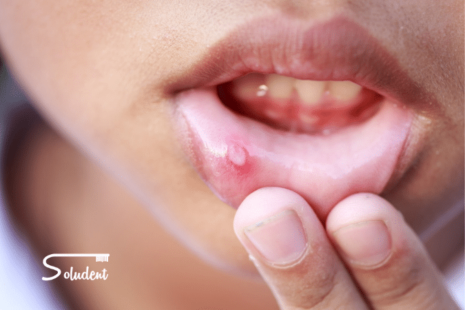 Helicobacter pylori en la boca clínica soludent