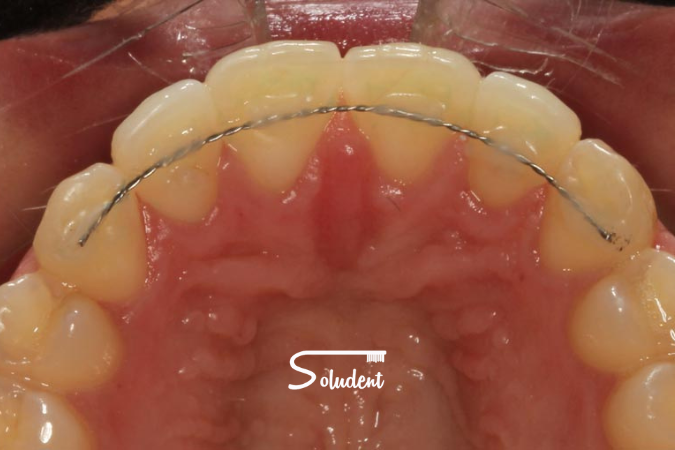 retenedores dentales