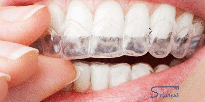 retenedores-dentales retenedor dental