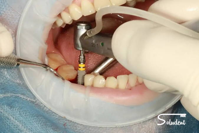cuidados para un implante dental soludent