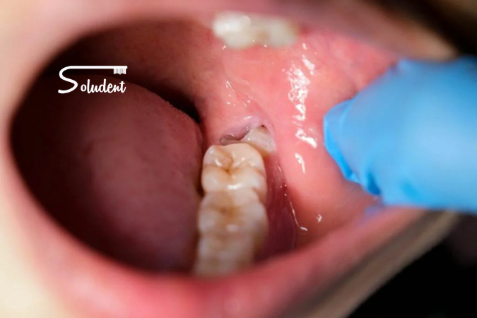 muelas del juicio soludent