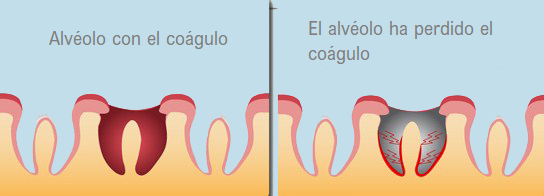 alveolitis