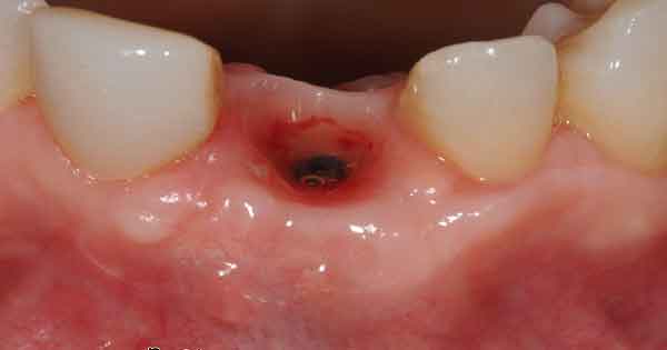alveolitis