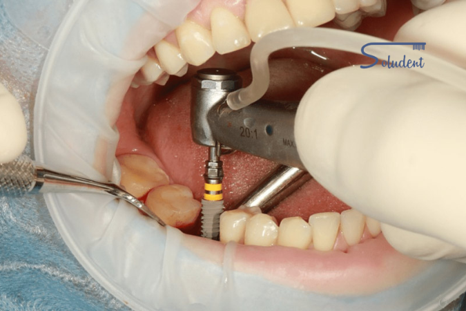 Implantes dentales en Alfaz del Pí