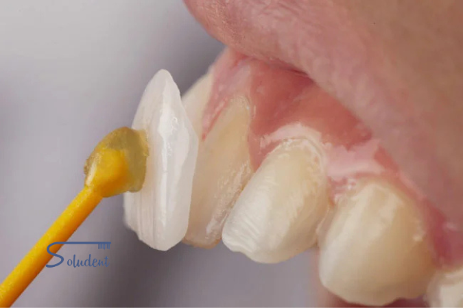 tratamiento de carillas dentales