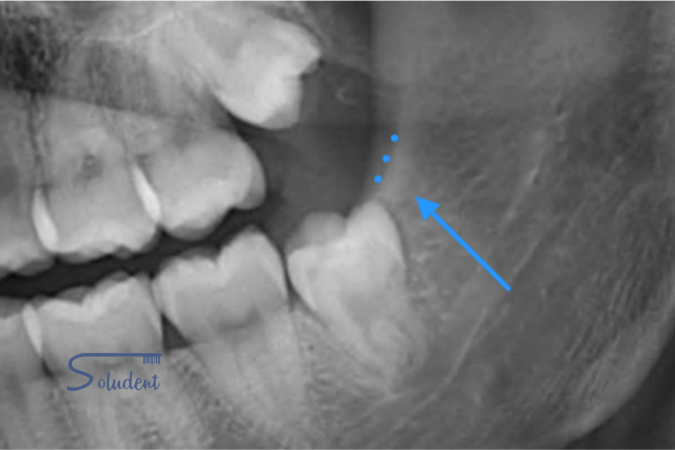 apiñamiento dental